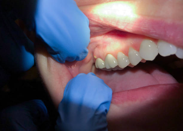 Best Emergency Root Canal Treatment in Leander, TX